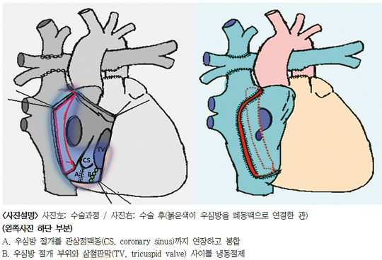 서울대병원 연구팀, 부정맥 예방 안전한 심장수술법 개발