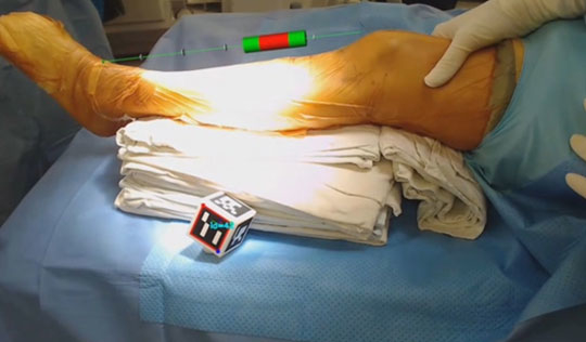 태블릿 PC환경서 ‘골종양 수술’…뼈 살려 팔·다리 기능 극대화ㅣ
