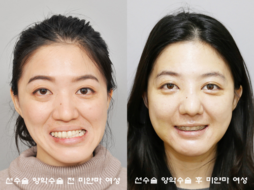 얼굴비대칭 미얀마 여성, 한국서 선수술 양악수술로 웃음 찾아