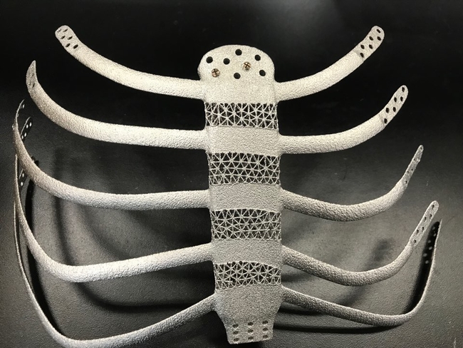 3D프린팅 인공흉곽 이식, 국내 첫 성공