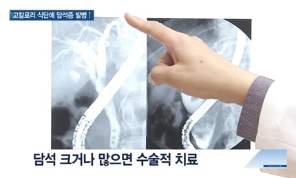 [쿠키건강뉴스] 고칼로리 식단·운동 부족…늘어가는 담석증 환자