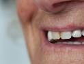 치아 교정에 ‘늦은 나이’ 없다…노년 환자 증가